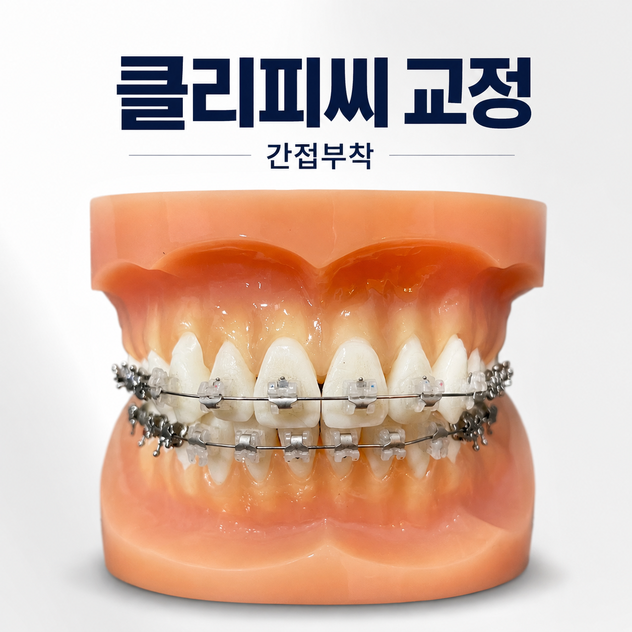 클리피씨 브라켓